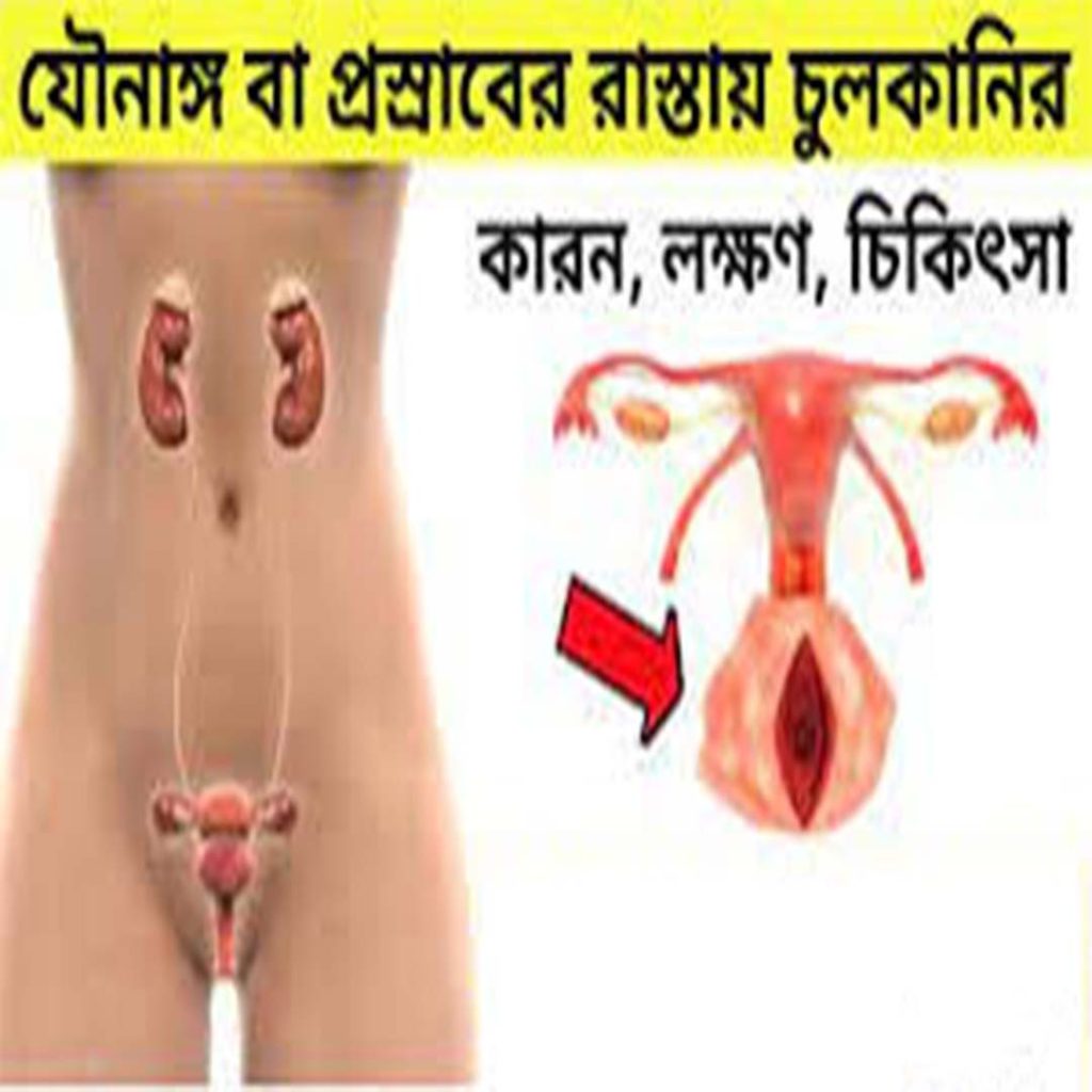 যৌনাঙ্গে চুলকানির কারণ – সমস্যা, প্রতিকার ও সচেতনতা গাইড 2